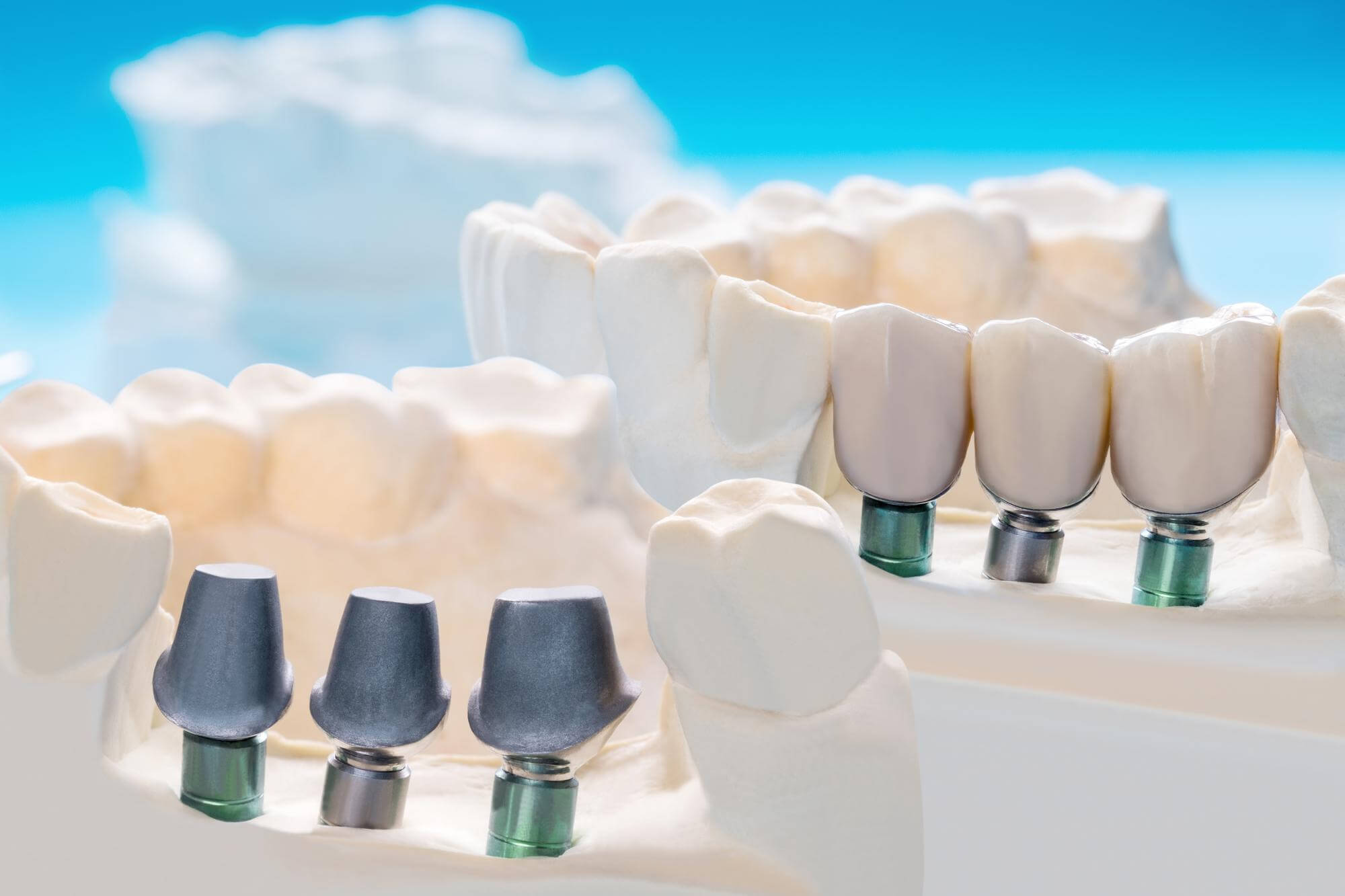 What are Dental Crowns and Tooth Bridges? South Anchorage Dental Center